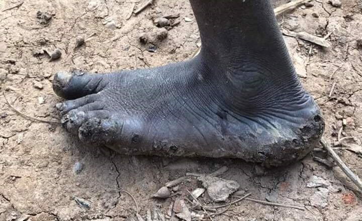 Over 400 Families in Rukungiri Infected with Jiggers